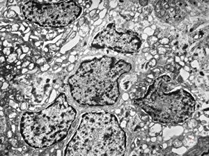 M,1y. | plexus papilloma M,1y. | plexus papilloma